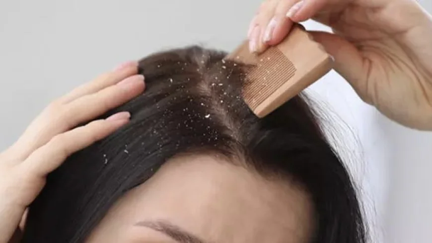 When Winter Turns Your Scalp Into Snowfall: Why It Happens and How You Can Actually Fix It
